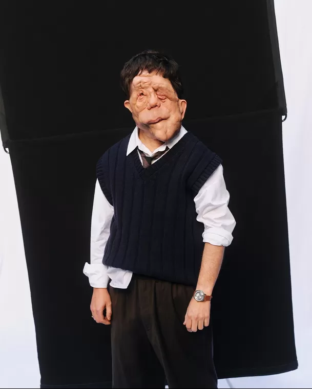 Adam Pearson fue diagnosticado con la afección genética llamada neurofibromatosis tipo 1 cuando era niño / Instagram Adam Pearson fue diagnosticado con la afección genética llamada neurofibromatosis tipo 1 cuando era niño / Instagram