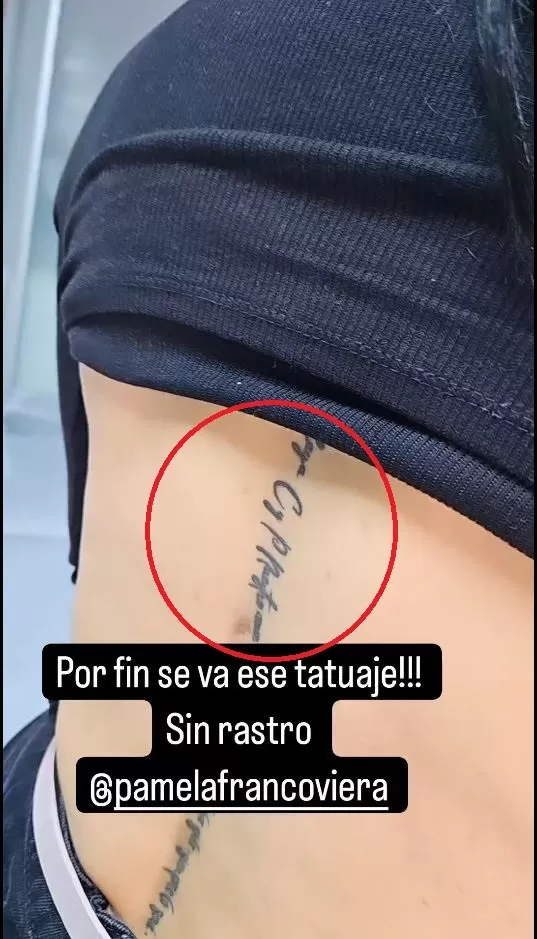 Pamela Franco se sometió a una sesión de láser para eliminar el tatuaje que se hizo por Christian Domínguez/Foto: Instagram