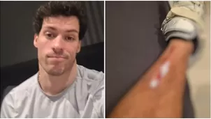 Patricio Parodi mostró dolorosa herida que sufrió tras fuerte golpe / Instagram