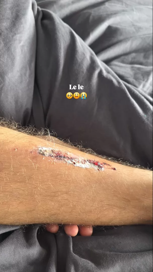 Patricio Parodi mostró dolorosa herida que sufrió tras fuerte golpe / Instagram Patricio Parodi mostró dolorosa herida que sufrió tras fuerte golpe / Instagram