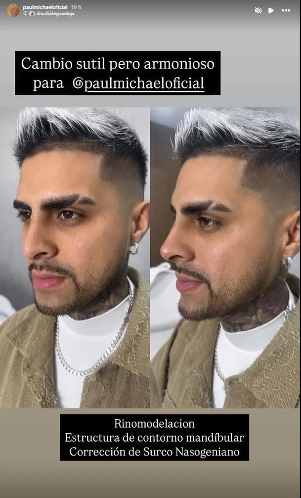 Paul Michael compartió resultado de su retoque estético. Fuente: Instagram