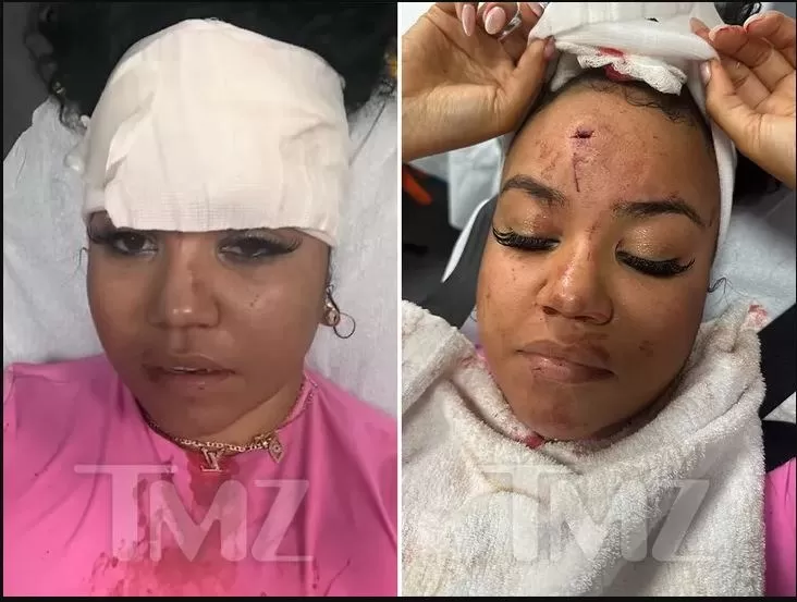 Así quedó la frente de la locutora radial Bryhana Monegain víctima de agresión del rapero '50 Cent'/ Fotos: TMZ 