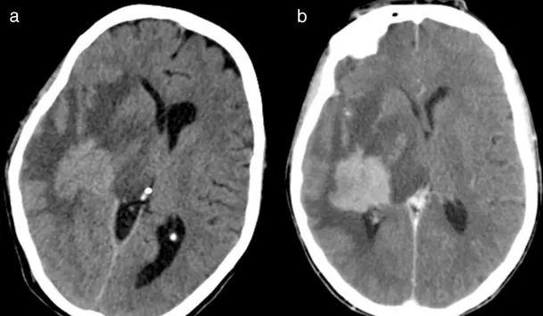 Raphael fue diagnosticado de linfoma cerebral