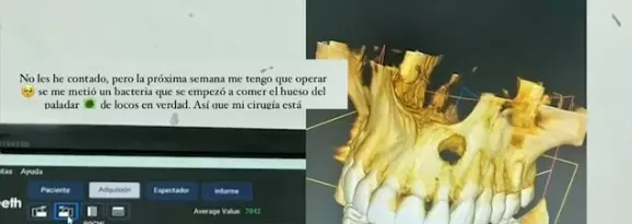 Valeria Piazza reveló que adquirió una infección bacteriana que ha dañado parte de su paladar. Foto: Instagram