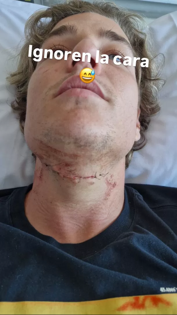 Tomi Narbondo impactó al mostrar terrible cicatriz de su operación