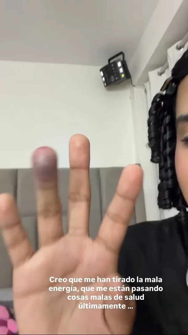 Así quedó el dedo de Valentino Palacios / Instagram Así quedó el dedo de Valentino Palacios / Instagram