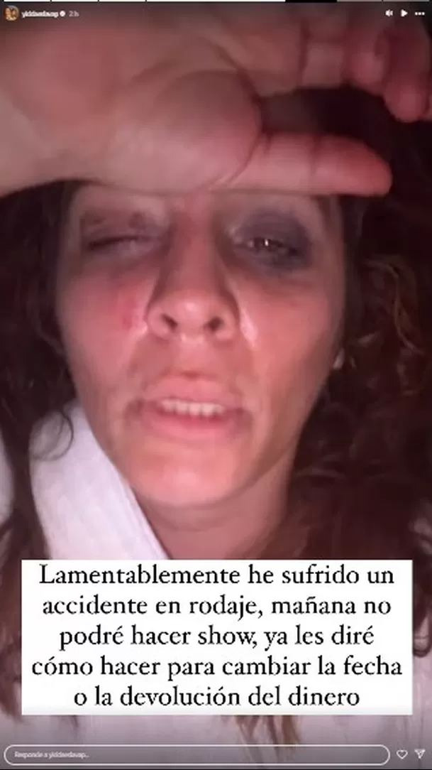 La actriz mostró imágenes de la lesión que sufrió en el ojo durante rodaje de su próxima película. Fuente: Instagram La actriz mostró imágenes de la lesión que sufrió en el ojo durante rodaje de su próxima película. Fuente: Instagram