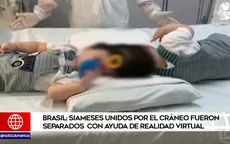 Brasil: siameses unidos por el cráneo fueron separados con ayuda de realidad virtual - Noticias de sucesion-presidencial