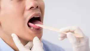 COVID-19: Lesiones en la lengua y manchas en pies y manos podrían ser síntomas del coronavirus, según un estudio. Foto: iStock referencial