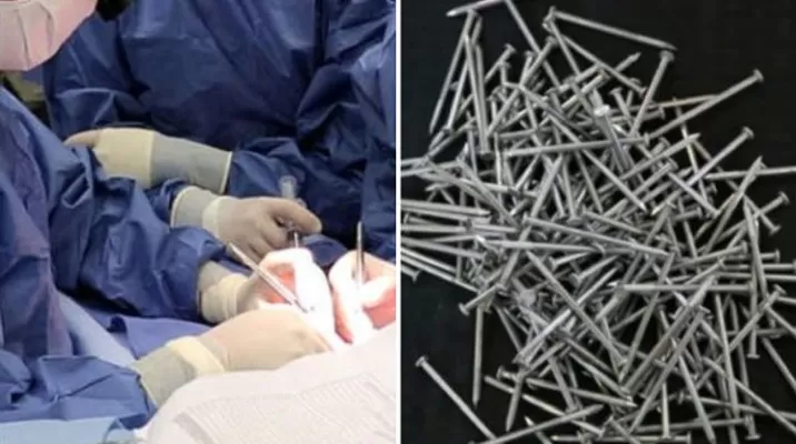 Además de los 112 clavos de 10 cm de largo, los médicos extrajeron cuatro chinchetas, dos agujas, un mondadientes y varios pedazos de vidrio. (Foto: Composición) Además de los 112 clavos de 10 cm de largo, los médicos extrajeron cuatro chinchetas, dos agujas, un mondadientes y varios pedazos de vidrio. (Foto: Composición)
