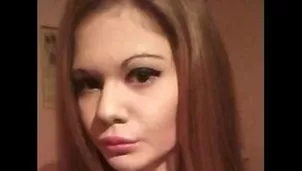 Joven se sometió a 15 cirugías para triplicar el tamaño de sus labios, ahora luce irreconocible. Foto: Iprofesional.com