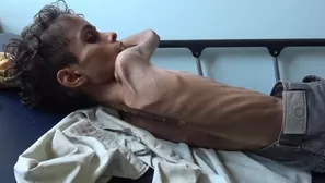 85.000 ni&ntilde;os han muerto de hambre desde que se intensificaron las hostilidades en la guerra del Yemen. (Foto: AFP)