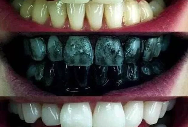 pasta dental carbon activado contraindicaciones