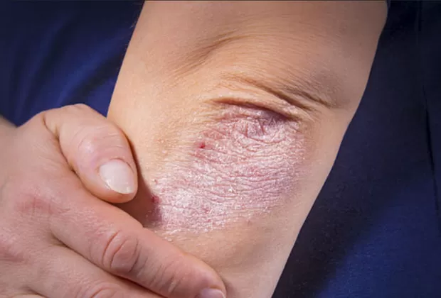 psoriasis causas y tratamiento