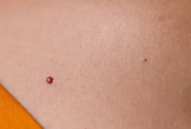 por que salen puntos rojos en el cuerpo