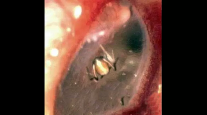 Araña hallada en la oreja de la joven. Foto: Daily Mail Araña hallada en la oreja de la joven. Foto: Daily Mail