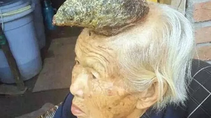 La protuberancia en la cabeza de Liang Xhizhen mide 12 centímetros. Via: Daily Mail La protuberancia en la cabeza de Liang Xhizhen mide 12 centímetros. Via: Daily Mail