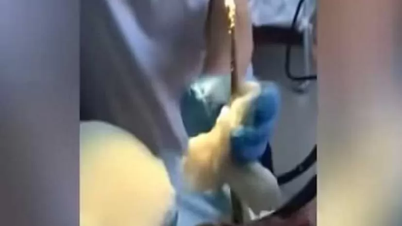 Facebook viral: Médicos sacan una serpiente de un metro de la garganta de una mujer