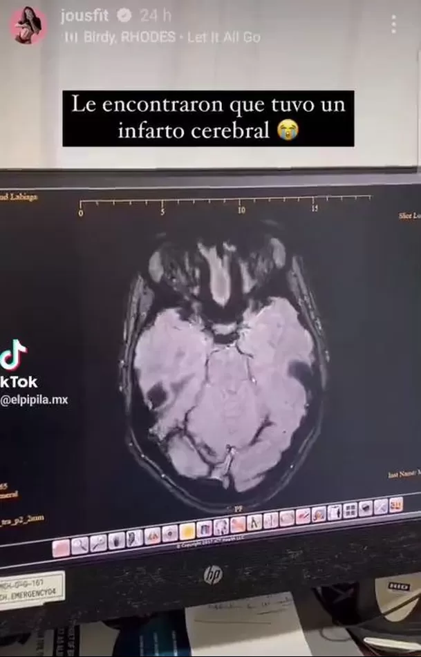 ¿Jousfit sufrió un infarto cerebral tras inyectarse bótox? 