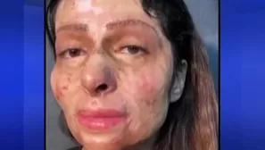 El video de la reacci&oacute;n de la mujer con el rostro quemado tras su transformaci&oacute;n es viral en Instagram con miles de reproducciones. (Foto: Captura/Video: Canal N)