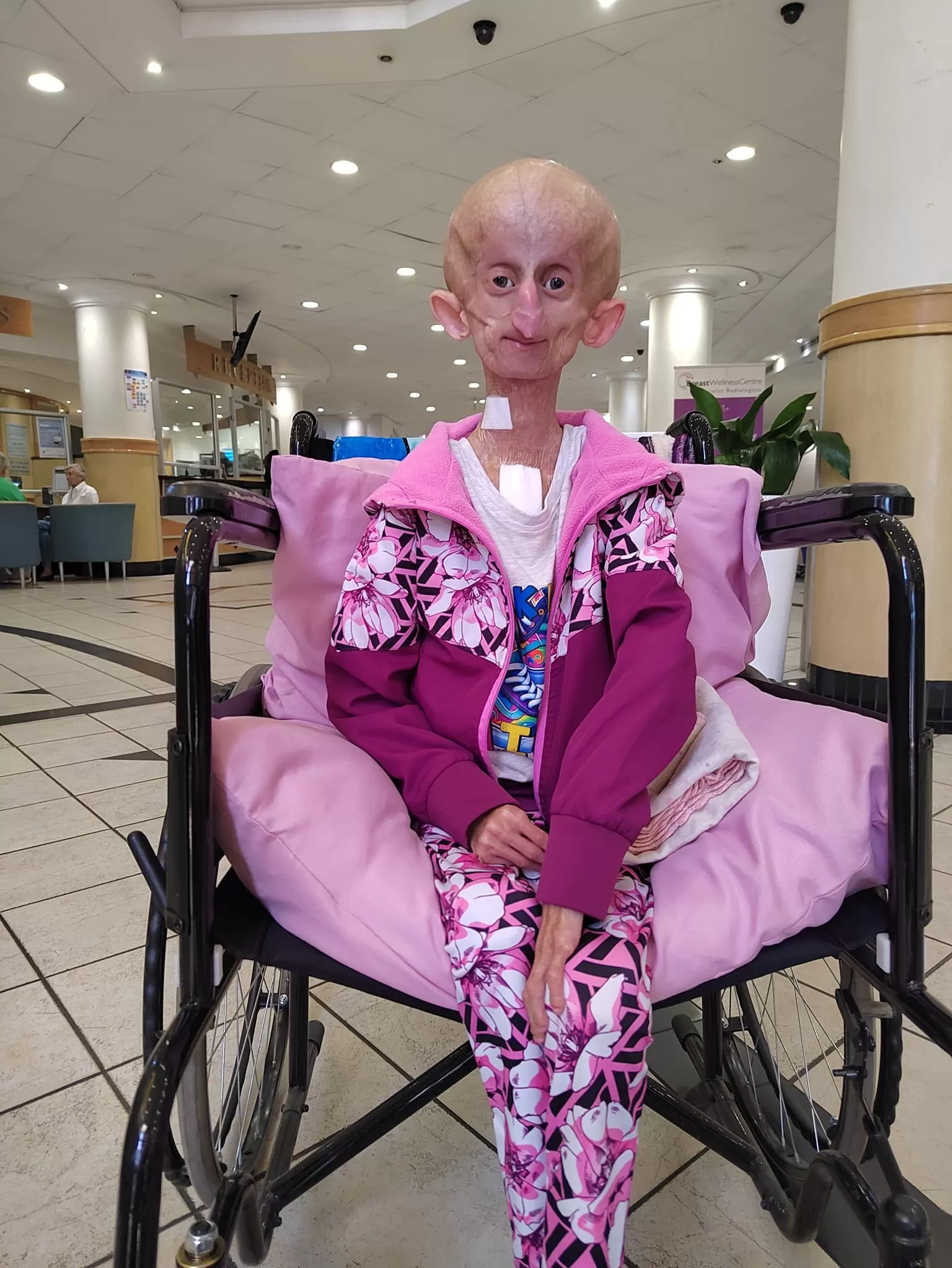 Beandri Booysen se hizo conocida a nivel mundial al tocar el tema del síndrome que padecía: Progeria de Hutchinson-Gilford / Facebook