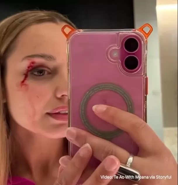 La periodista mostró cómo quedó su rostro tras ataque de gaviota / Instagram La periodista mostró cómo quedó su rostro tras ataque de gaviota / Instagram