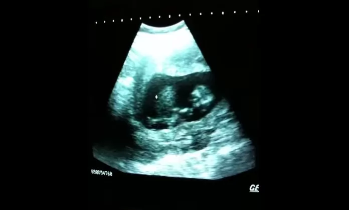Youtube Bebe Juega En El Vientre De Su Madre Con Apenas Tres Meses De Gestacion America Noticias