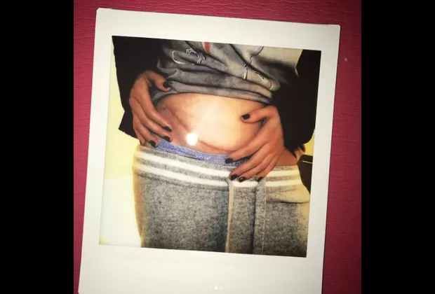 Selena Gómez se sometió a un trasplante de riñón 