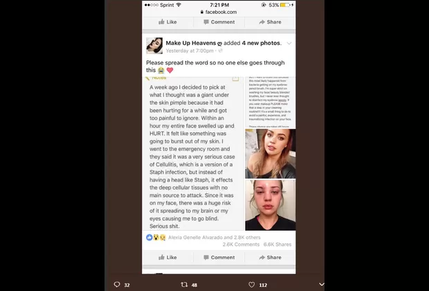 Reventarte espinillas