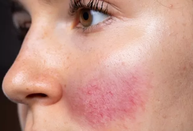 como saber si tengo rosacea