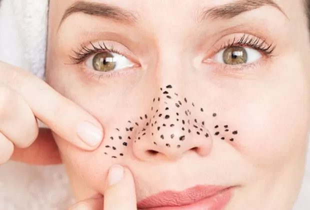 puntos negros en el rostro