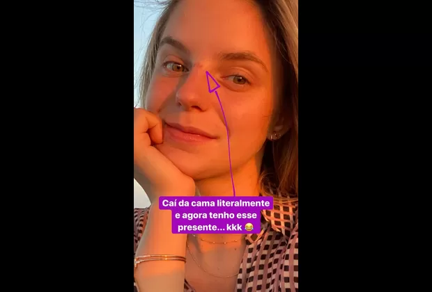 Thaísa Leal muestra cómo quedó su rostro tras sufrir accidente doméstico