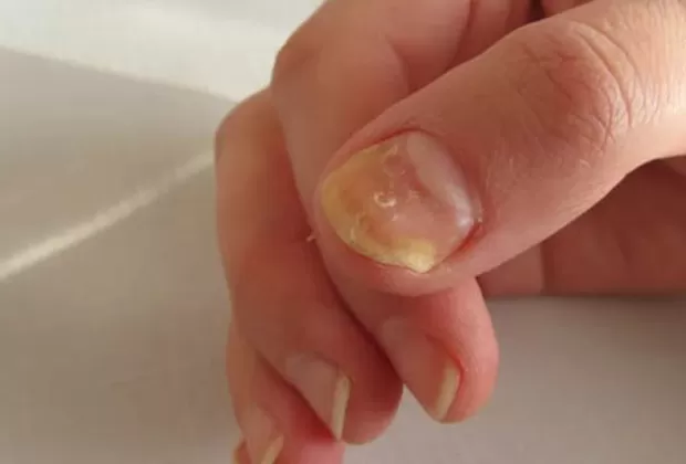¿Las uñas amarillas son señal de problemas en el hígado?
