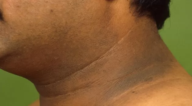 Acantosis nigricans: ¿por qué se oscurecen estas zonas del cuerpo?