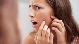 Descubre cómo desinflamar un grano manera natural