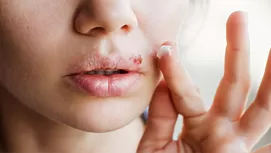 ¿Por qué salen aftas en la boca y cómo puedes prevenirlas?