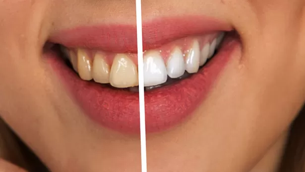 Alimentos y tips para tener los dientes más blancos