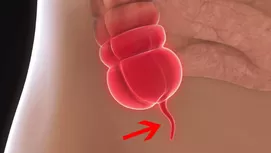 Apendicitis: ¿A qué lado duele y cuáles son los síntomas?