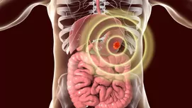 Helicobacter pylori: ¿cómo se transmite y cuáles son los síntomas?