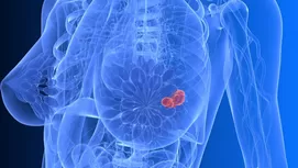 Los síntomas del cáncer de mama en mujeres y hombres