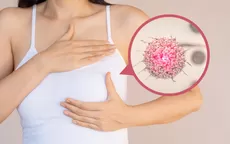 Cáncer de mama: ¿En qué casos se hace una mastectomía? - Noticias de ministro-salud