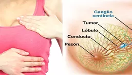 ¿Cómo se da el cáncer de mama en hombres y cómo detectarlo?