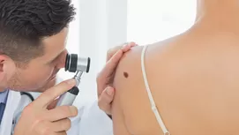 ¿Es normal nacer con un lunar o adquirirlo en el tiempo?