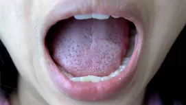 ¿Cómo se curan las aftas bucales?