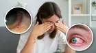 ¿Cómo aparecen las várices en los ojos? Características y causas
