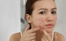 Las formas más efectivas de borrar las marcas que deja el acné - Noticias de repechaje-mundial