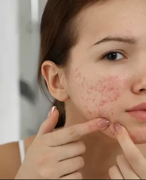 Las formas más efectivas de borrar las marcas que deja el acné