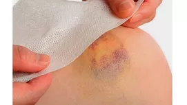 ¿Por qué te salen moretones en el cuerpo sin golpearte?