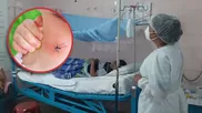 ¿Cómo saber si un cuadro de dengue se volvió grave?