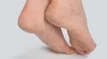 Causas de los pies secos, agrietados y escamosos.
